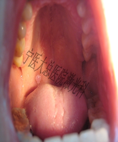 异位皮脂腺口腔图片